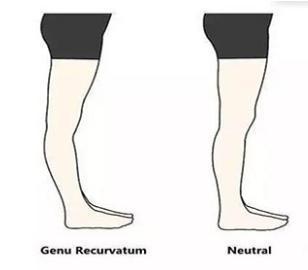 膝关节活动受限腿伸不直怎样处理,膝关节手术后伸不直怎么锻炼