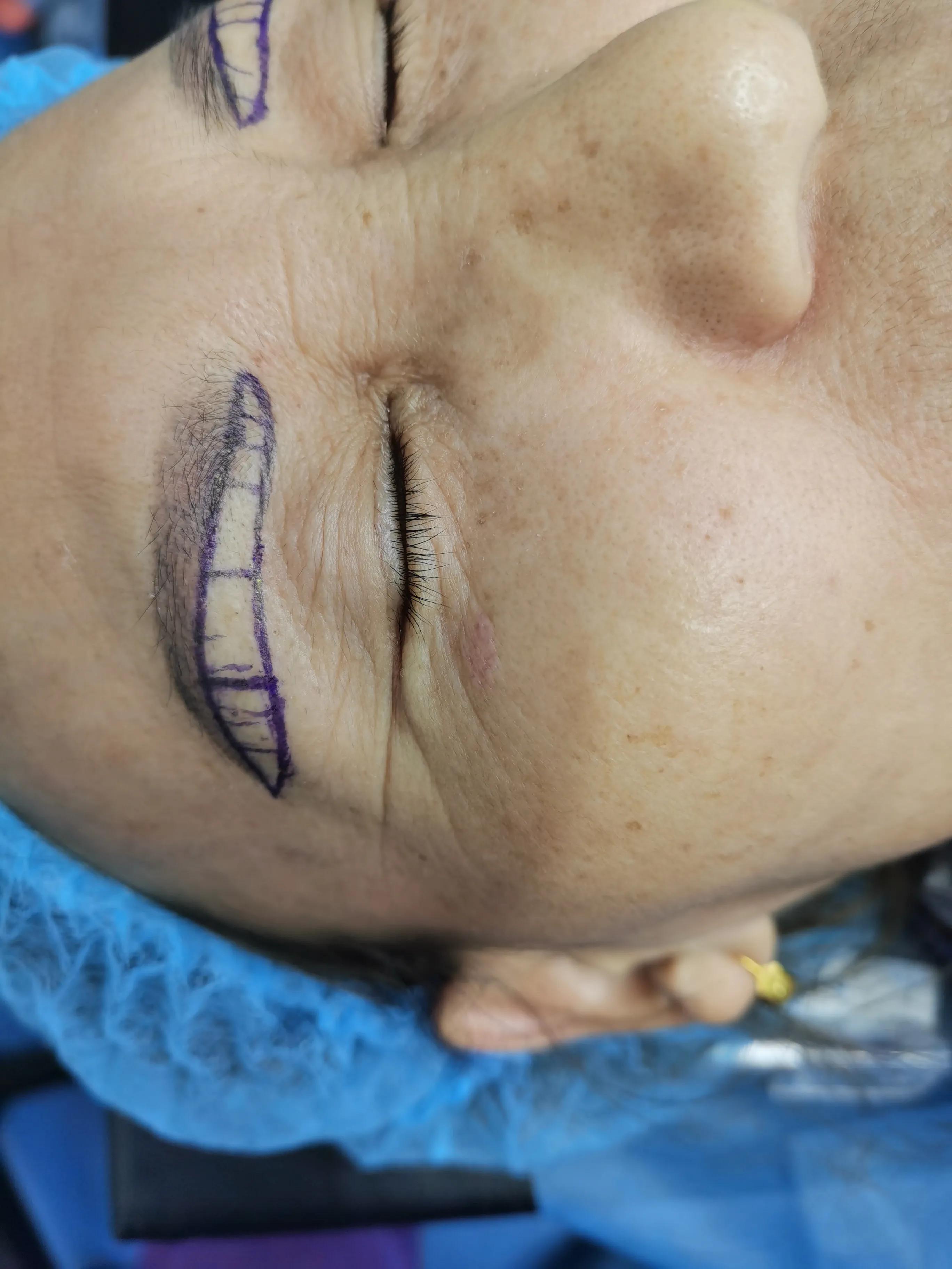 整形手术除皱会反弹吗,整形手术会不会有后遗症