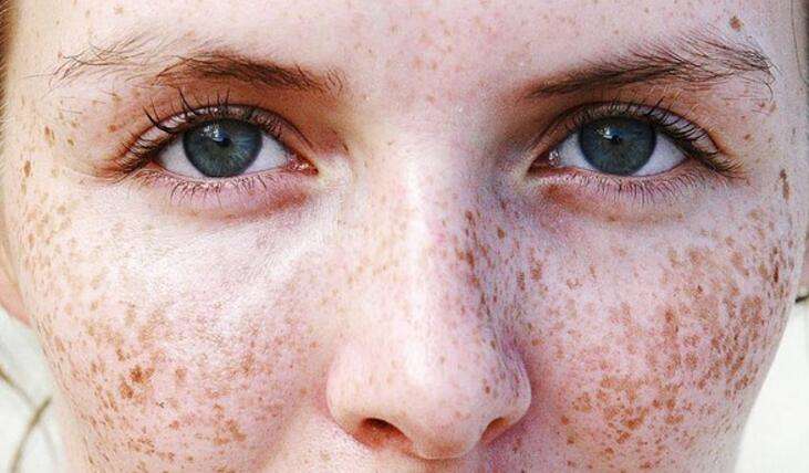这就是你一直在找的安全有效祛斑法,三分钟学会14天淡斑