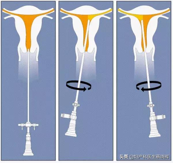 宫腔镜手术后亲身经历,宫腔镜手术提早做还是备孕前做