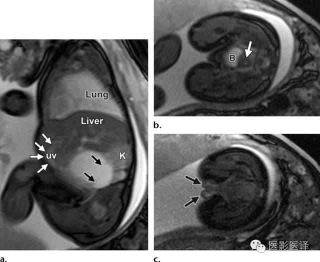 孕期发现卵巢囊肿有8cm左右,孕19周查出胎儿卵巢囊肿