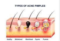 大腿毛孔粗大是什么原因造成的,汗毛孔粗大一般是什么原因