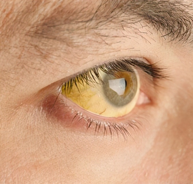 肝硬化健康教育微视频,健康养生知识肝硬化