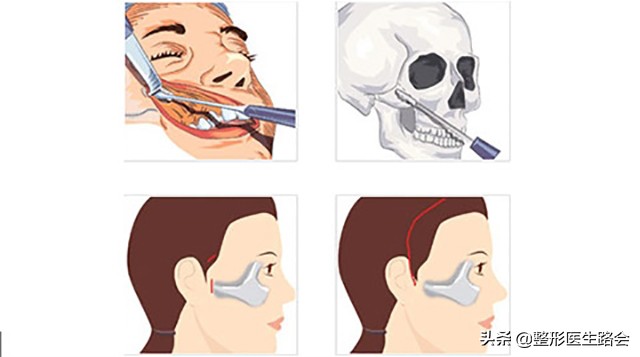 颧骨内推和颧弓有何区别,颧骨内推和颧突有什么区别