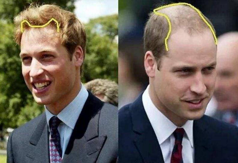 女孩子常见的基因缺陷,4种遗传病不传女儿