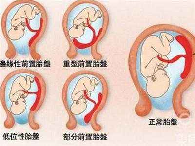 胎盘前置很危险孕妈千万要当心,完全性前置胎盘高危风险等级