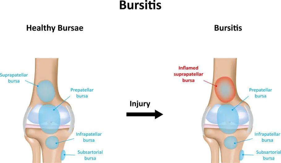 上下楼腿弯疼痛是什么原因,哪几种病导致上下楼梯膝盖疼