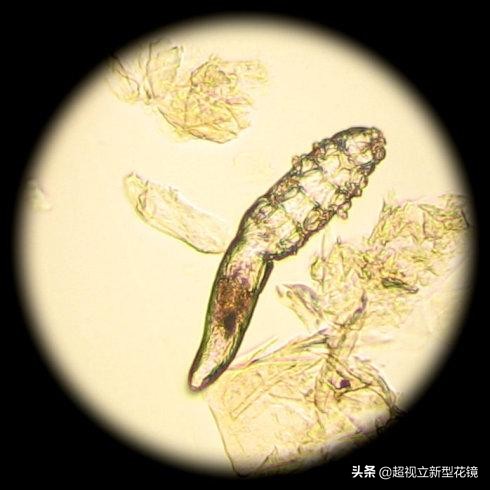 如何给眼睛除螨,眼睛除螨虫最有效方法