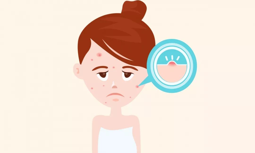 依雪护肤时常犯的错,长痘可以敷雅莎尔面膜吗