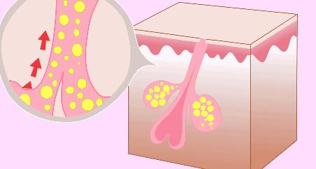 毛孔粗大怎么办最有效收缩毛孔,毛孔粗大怎么办怎么有效收缩毛孔