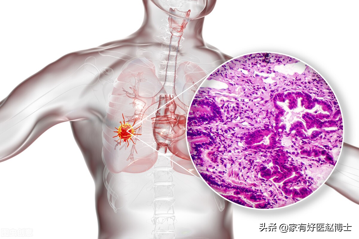 六大高发癌症早筛攻略,六大癌症有哪些