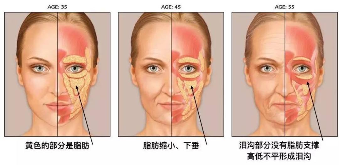 目前填充法令纹最好的办法,永久填充法令纹的方法