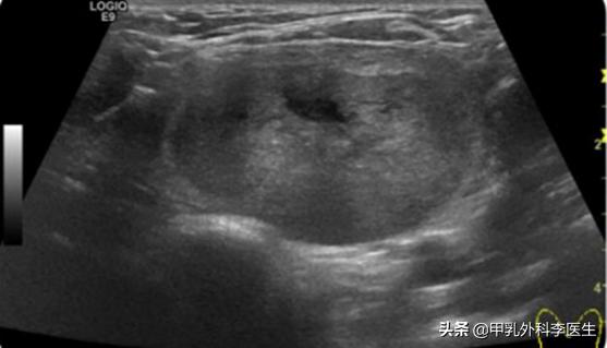 消融术治疗甲状腺结节要多久能好,甲状腺开刀还是消融术