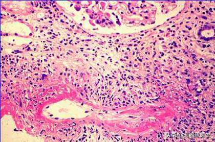 「免疫相关不良妊娠答疑解惑40」——系统性血管炎