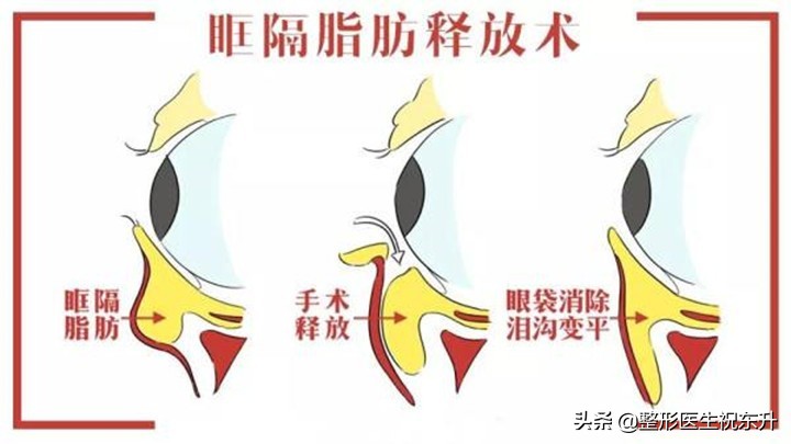 关于祛眼袋那点事,医生讲去眼袋是真的吗