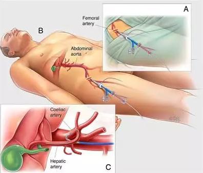 中国首例肝癌已手术,一台一百多亿的治疗癌症机器