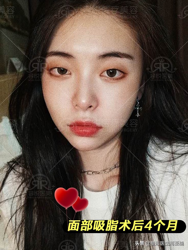 面部吸脂后如何快速消肿,面部吸脂去哪做