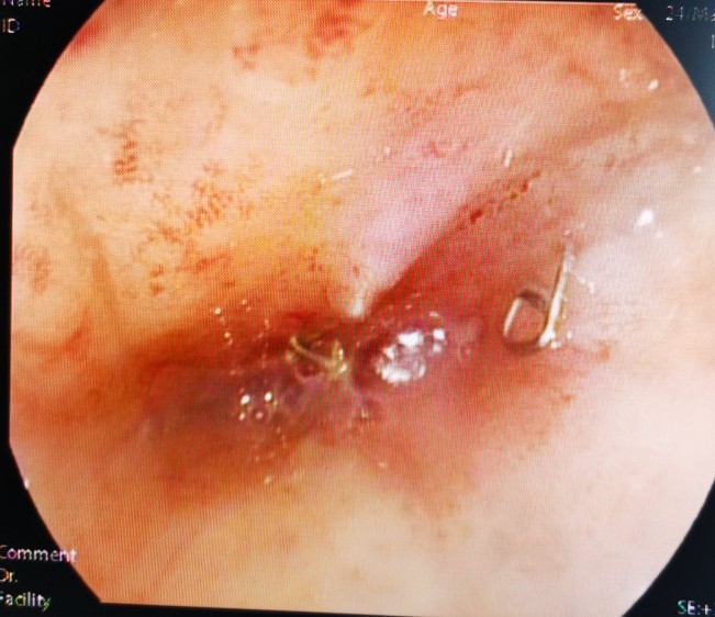 直肠癌吻合口狭窄的症状,直肠癌术后吻合口狭窄什么原因