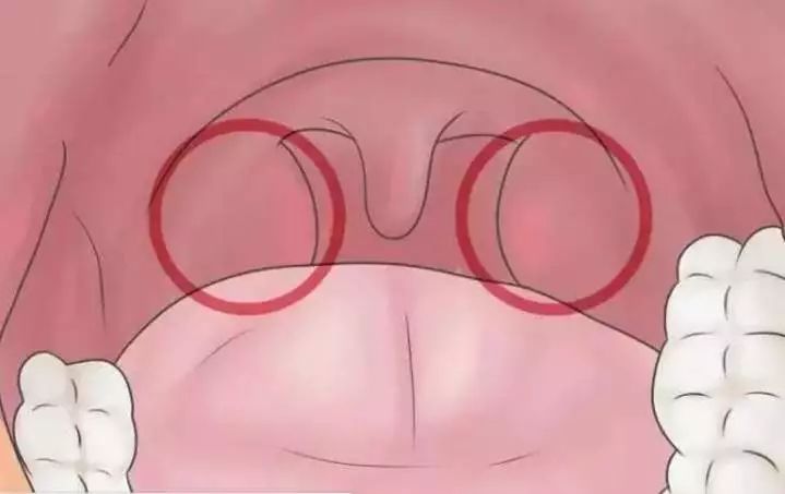 扁桃体发炎与扁桃体癌的区别,扁桃体瘤和扁桃体癌的区别