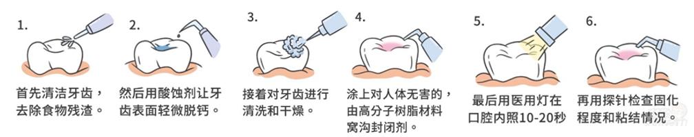 涂氟还是窝沟封闭,涂氟窝沟封闭有必要做吗