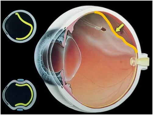 视网膜脱落复位不完全怎么办,孔源性视网膜脱落能恢复视力吗