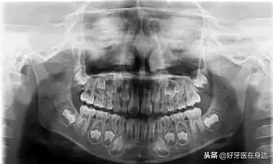 孩子出现双排牙要注意什么,1周岁双排牙怎么处理