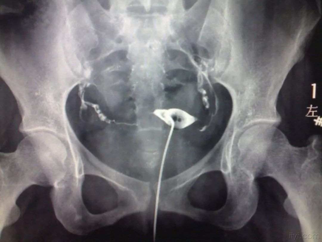 没做过人流,为何也成为输卵管堵塞的受害者?