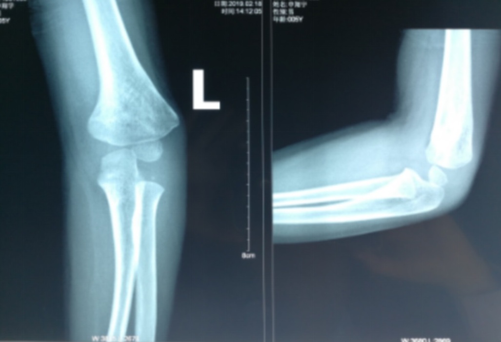 肘关节骨折出现的后遗症,肘关节陈旧性骨折肘内翻