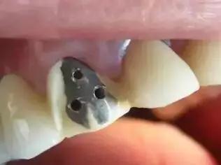 做了烤瓷牙后悔了有补救办法吗,做了烤瓷牙后悔了怎么补救