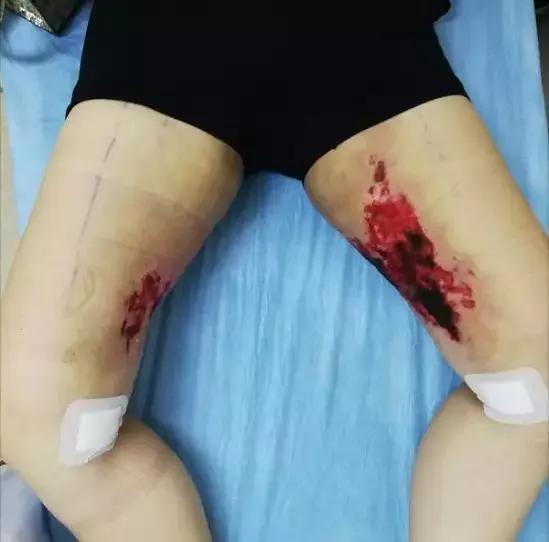 苏州科技城医院烧伤整形科｜谨防烧烫伤，变成一个更美好的你