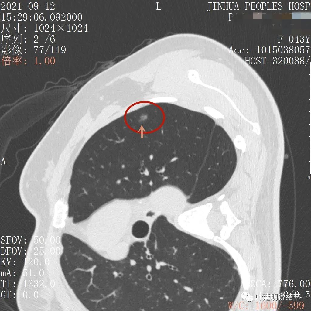 怎样从病理报告看是不是原位癌,原位腺癌切除子宫要开刀吗