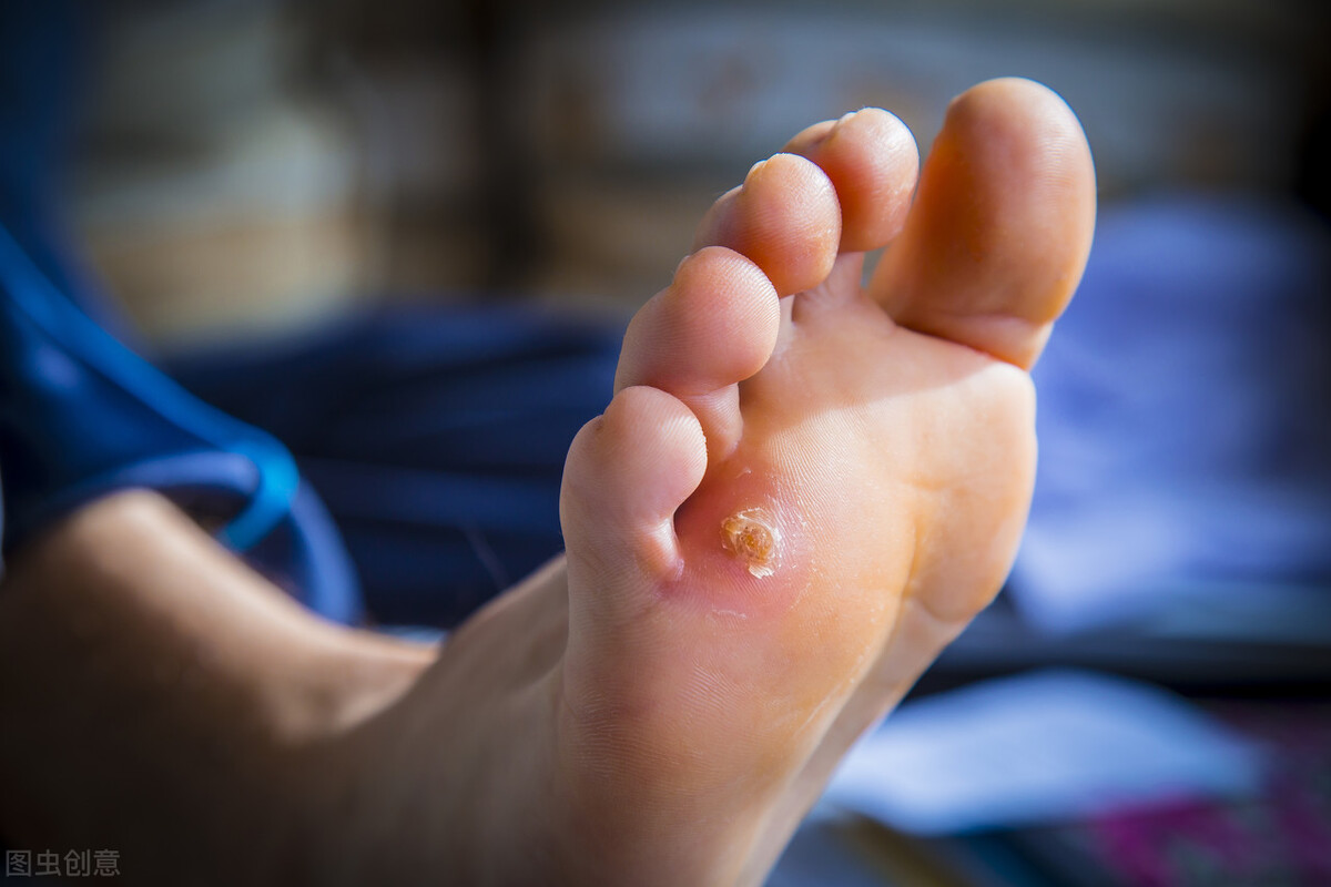 脚底长个鸡眼怎么治才除根,脚底长了鸡眼怎么去掉