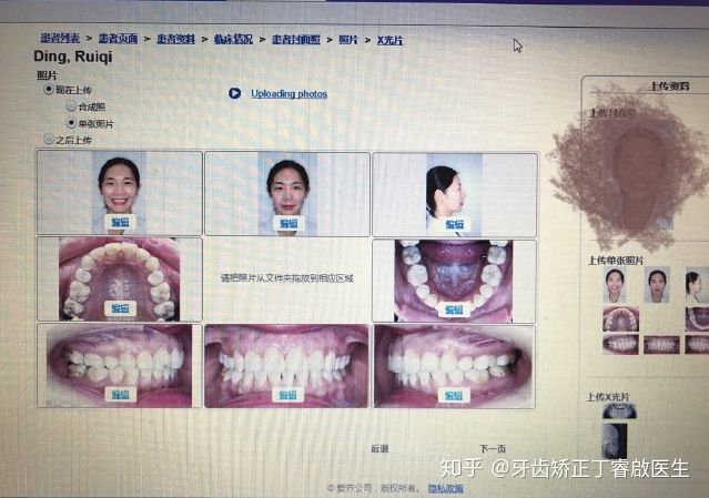 隐适美牙套矫正手法,隐适美牙套矫正的全过程