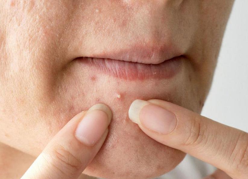 痘痘可以挤吗正确处理方法告诉你,哪种痘痘能挤哪种痘痘不能挤