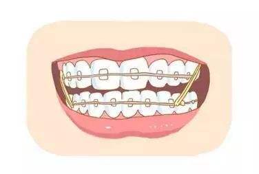 牙齿矫正选择了就不要轻易放弃,牙齿矫正刚开始就后悔了怎么办