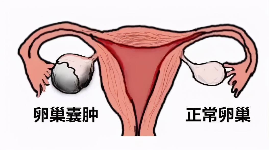 卵巢肿块需要怎么治疗,想备孕但是有子宫结节怎么办