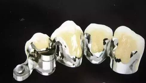 换一副烤瓷牙什么材料比较好,各类烤瓷牙材料的优缺点对比