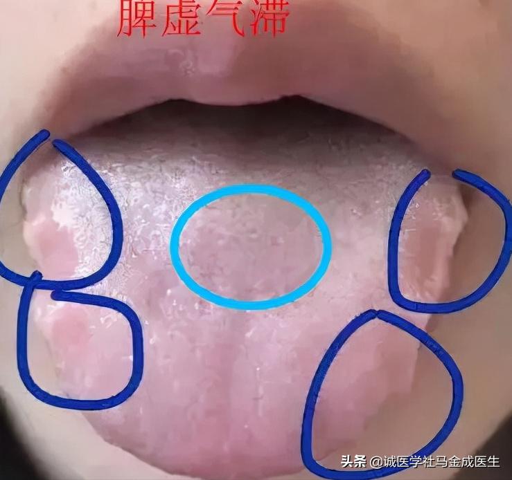 脾虚齿痕舌整天乏困吃什么中成药,治疗脾虚齿痕舌最好的中成药