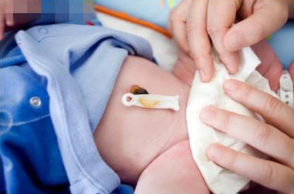 新生儿脐带有点出血怎么处理,新生儿脐带有点出血在家怎么处理