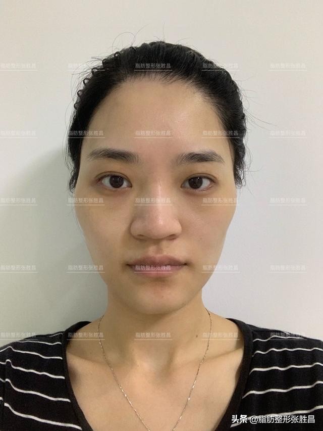 自体脂肪胶填充太阳穴泪沟法令纹,自体脂肪太阳穴填得太饱满了