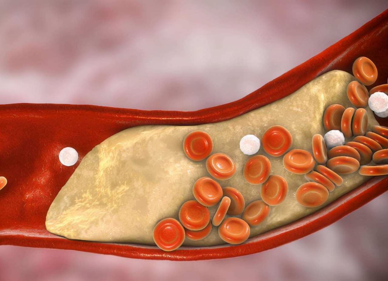 高血脂应该吃什么食物来控制血脂,血脂偏高吃米饭好还是吃面条好