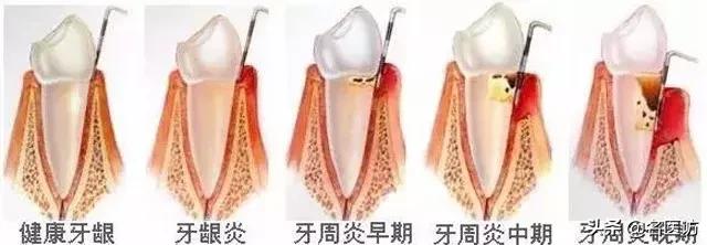 牙龈萎缩是什么原因引起的,牙龈萎缩专用药