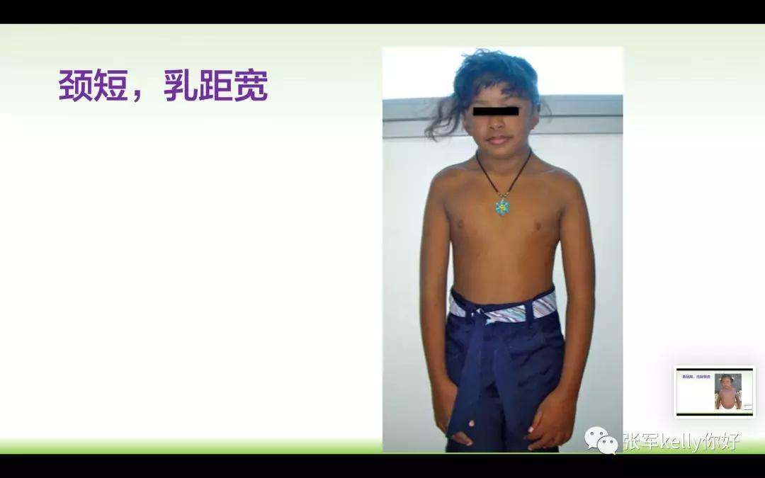 Turner综合征的指南学习