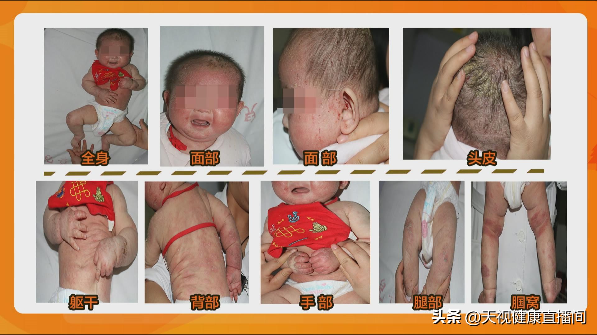 宝宝湿疹发作怎样安抚,家长如何防治婴儿湿疹