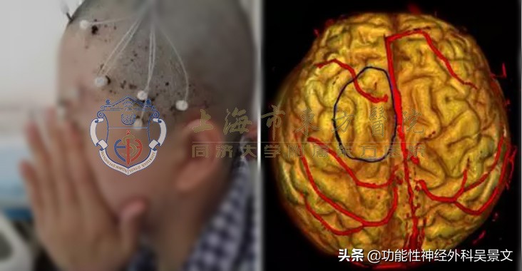 seeg微创手术技术,seeg微创怎么治疗癫痫