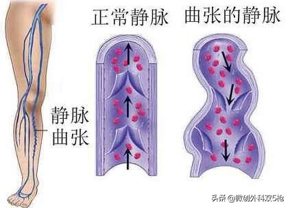 静脉曲张的腿怎么能穿裙子,静脉曲张夏天穿裙子怎样掩饰