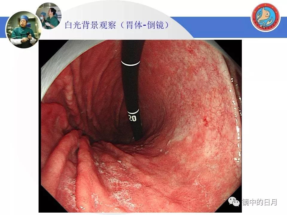 低分化胃癌早期时候做内镜手术吗,早期胃癌内镜手术后追加外科手术