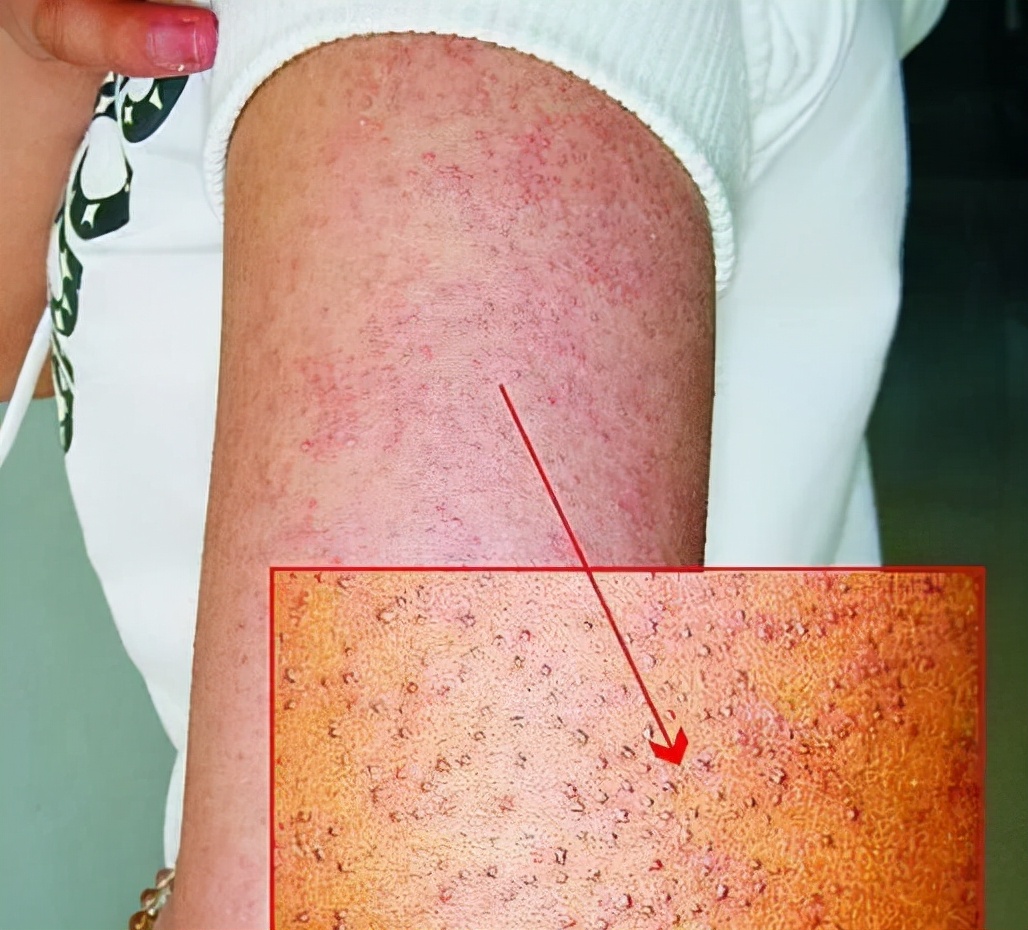 毛囊角化皮肤病专家治疗视频,治疗毛囊角化病的医院