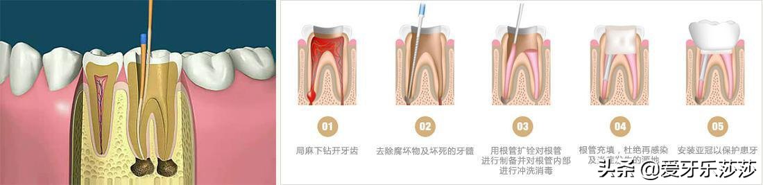 神经性牙疼怎么治牙髓炎,智齿牙髓炎引起牙疼怎么治疗