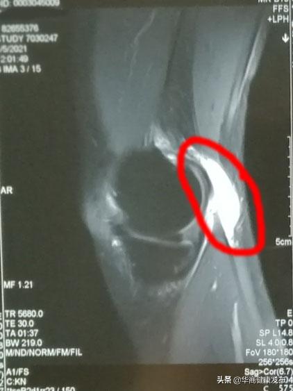 痛风发作在腿弯处有肿块,腿弯出现鸡蛋大肿块是怎么回事
